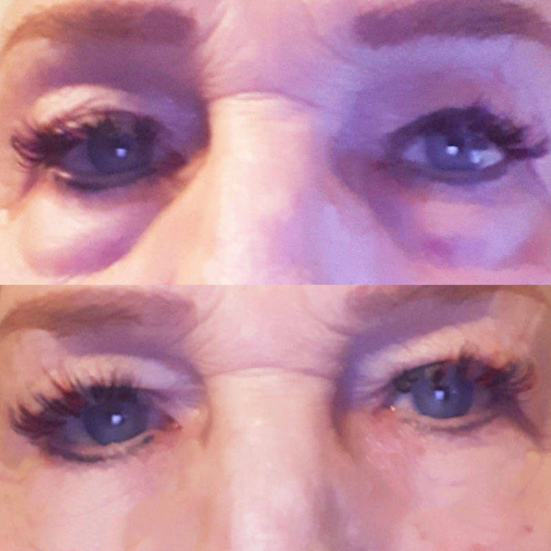 Glowmoon™ | Anti-dark circles and bags, Anti-wrinkle 2 in 1